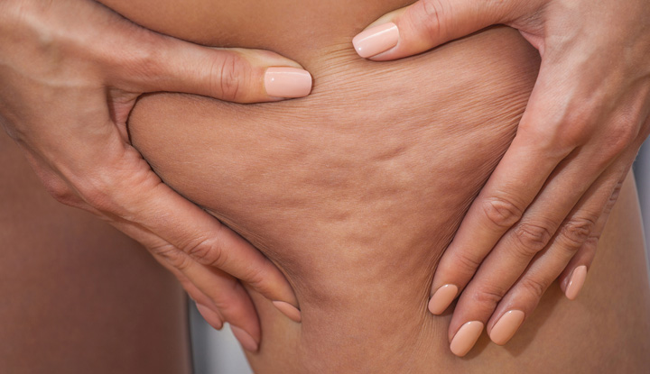 Cellulite Is Totally Normal And Natural – So Let’s Talk About It